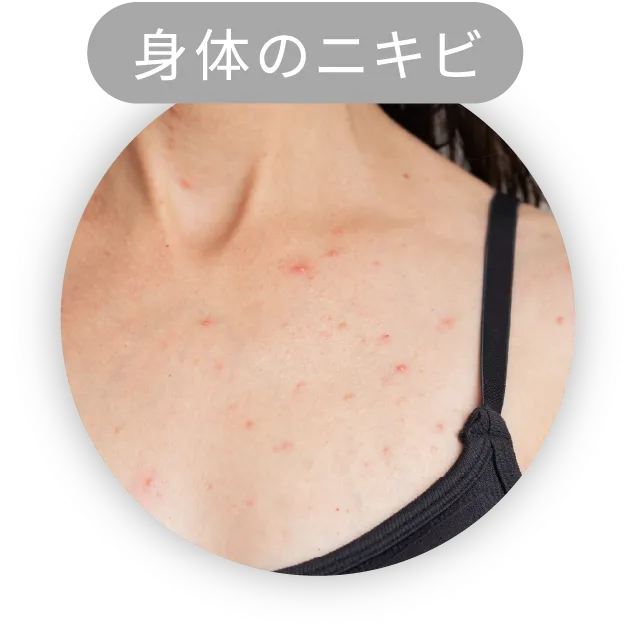 身体のニキビ