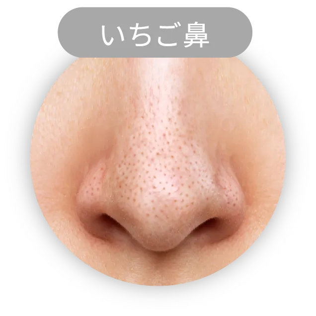 いちご鼻