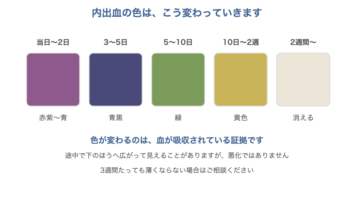 マンジャロの内出血の色が当日の赤紫から2週間で消えるまで変化していく様子を示した図
